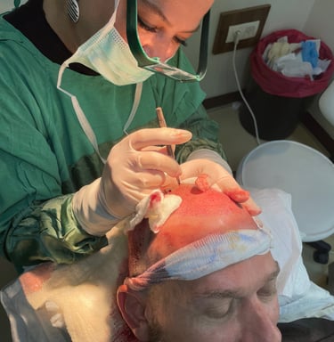 making the holes to replace the hair follicles in a hair transplant in Izmir in Turkey