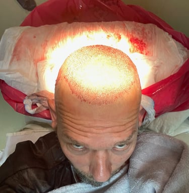 replaced hair follicles in a hair transplant in Izmir in Turkey