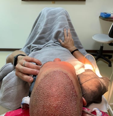 replaced hair follicles in a hair transplant in Izmir in Turkey