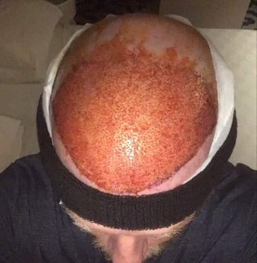 hair transplants that have just been complet