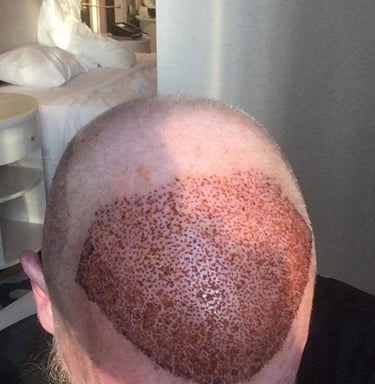 hair grafts in a forehead of a man