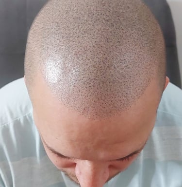 homme avec une calvitie qui a fait une miropigmentation capillaire