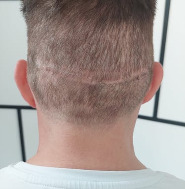 un homme avec une cicatrice sur le cuir chevelu