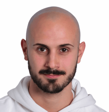 tricopigmentazione diego prima e dopo
