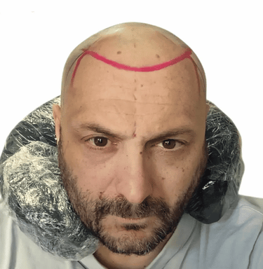 tricopigmentazione massimiliano prima e dopo