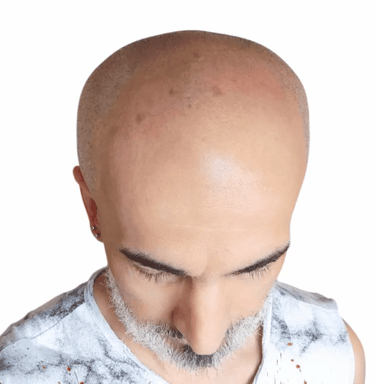 tricopigmentazione miki prima e dopo