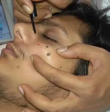 Dr. Shreya Patel, top skin specialist in Vadodara, removing viral wart of man, mole, skintag, viral wart removal