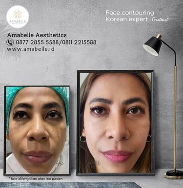 amabelle before after face contouring treatment