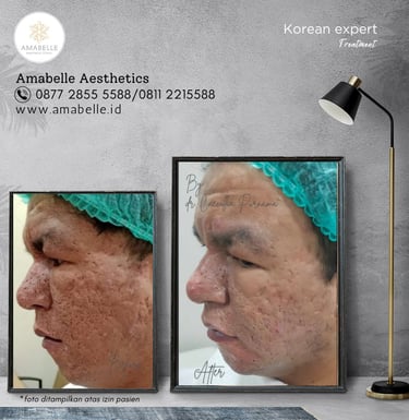 amabelle before after korean expert treatment