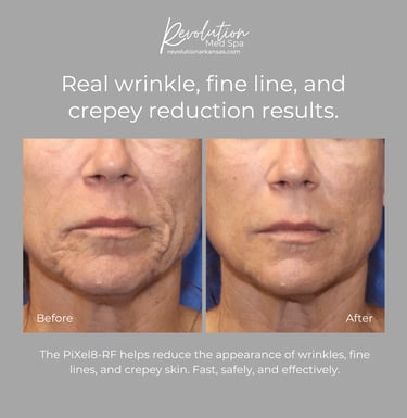 Real wrinkle, fine line, and crepey reduction results.  The Pixel-8 RF microneedling reduces lines.