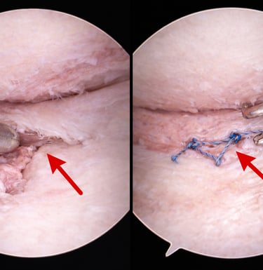 arthroscopie Réparation du ménisque lors d'une chirurgie