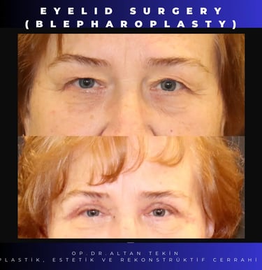 eyelid surgery before after photo in Antalya