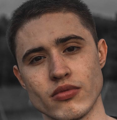 acné