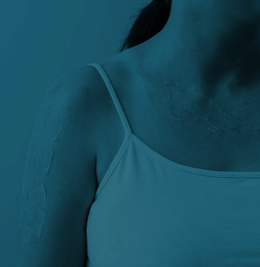 Tratamento de Queimaduras