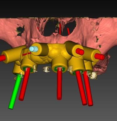 Planificación digital tridimensional para implantes dentales basada en anatomía ósea del paciente