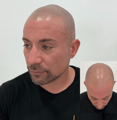 Solución capilar para pérdida de cabello en Madrid