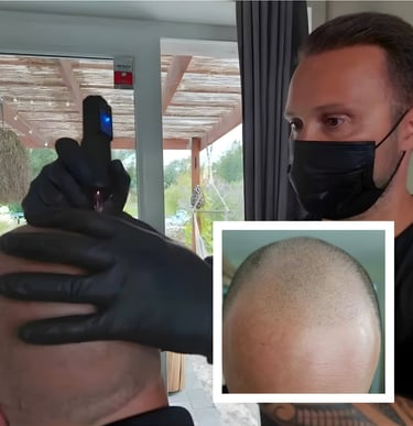 avant-après d'une greffe capillaire réussie