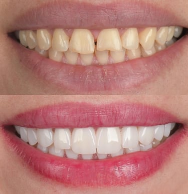 "white teeth, natural ways to whiten teeth, affordable dental clinic near me,teeth polishing