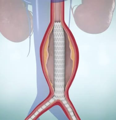 endovascular aortic aneurysm repair