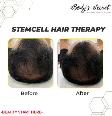 Body's Secret stem cell hair therapy