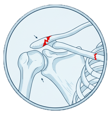 Fratura no Úmero (fraturas do Ombro e Clavícula)