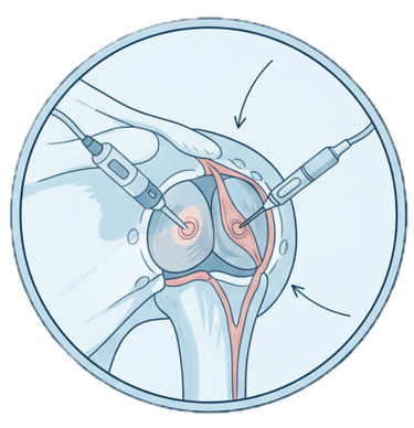 Artroscopia do Ombro