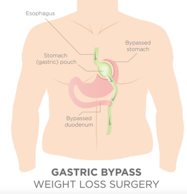 diagram of gastric bypass surgery with a small gastric pouch bypassing the stomach and duodenum