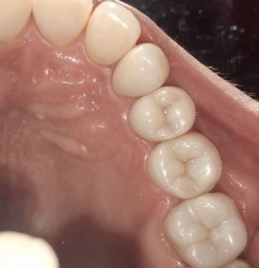 after rct and crown placement at shree dental care near shyamal ahmedabad