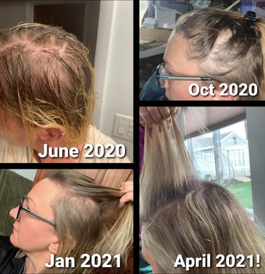 mujer con alopecia androgenetica