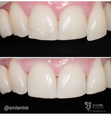 a close up of a smile with a toothbrush