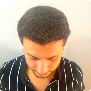 Cosmedic Express clinics in Turkey/Albania perform the worlds best hair transplants