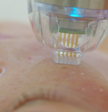 RF microneedling radiofrequency microneedling