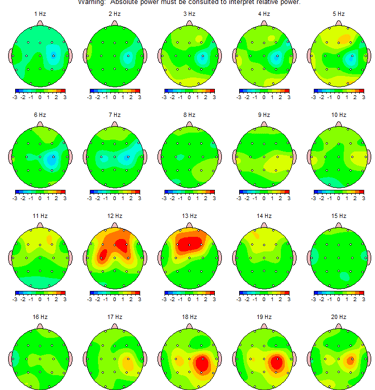 image d'un exemple de cartographie cerebrale 
