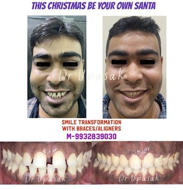 Before and after smile transformation results using orthodontic braces and clear aligners.