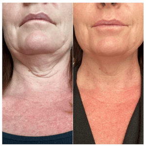 Lifevantage Collagen Before and After Results - woman neck