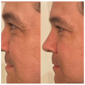 Lifevantage Collagen Before and After Results - man face (2)