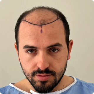 Cosmedic Express clinics in Turkey/Albania perform the worlds best hair transplants