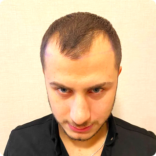 Cosmedic Express clinics in Turkey/Albania perform the worlds best hair transplants
