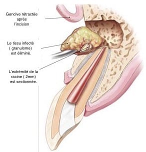 Chirurgie endodontique