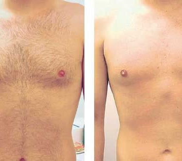 Depilação masculina abdomem