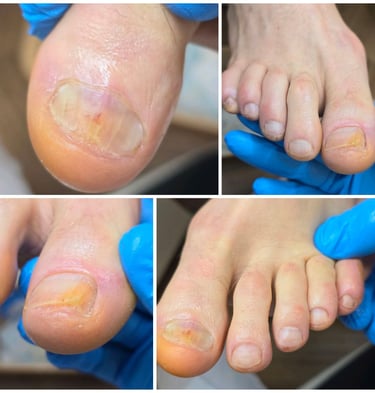 nagu grybelis gydymas pabaiga 2024 vasario 22 diena 2 diena