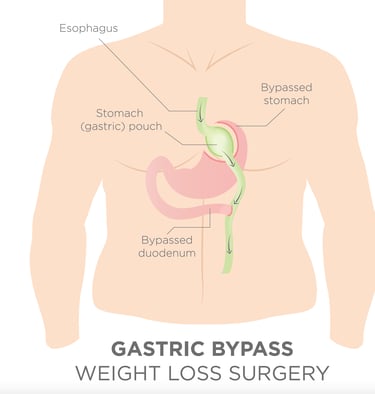 Gyomor bypass, Roux-en-Y gastric bypass