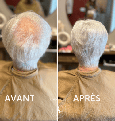 perte de cheveux femme