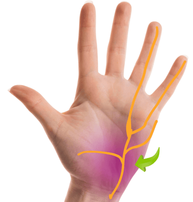 Sindrome de canal de guyon, cirugia de mano, nervios perifericos, dr tafur