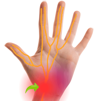 sindrome de tunel de carpo dr-david-tafur-cirujano-de-columna-vertebral