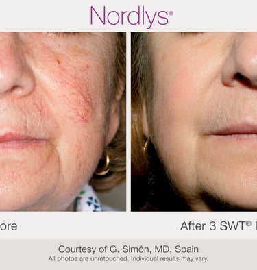 skin revitalization and rejuvenation before and after results in Hamilton skincare clinic