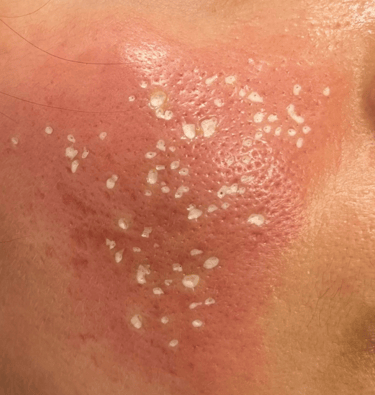 TCA cross chemical peel
