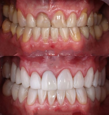 smile makeover, smile correction, smile designingdental treatments at low cost invisible braces"