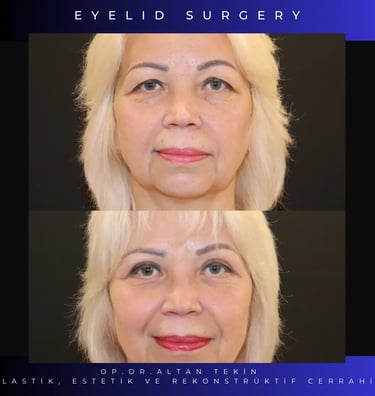 before after photo eyelid surgery