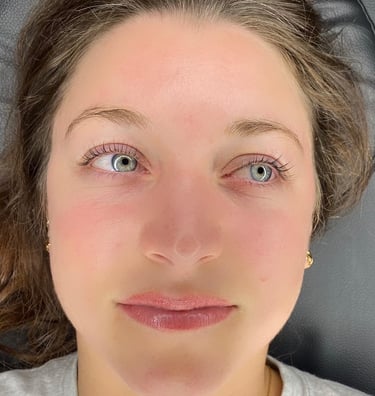 woman after microneedling